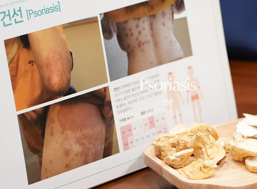 생기한의원으로 보는 건선 초기 피부 변화 확인 포인트